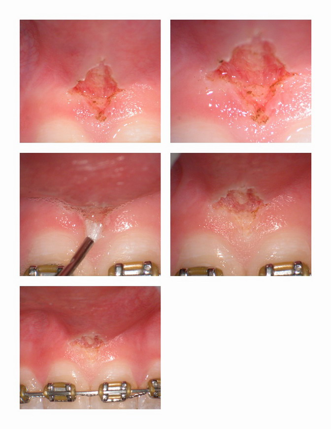 Frenectomy pg 2.jpg